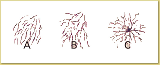 Illustration of spider veins