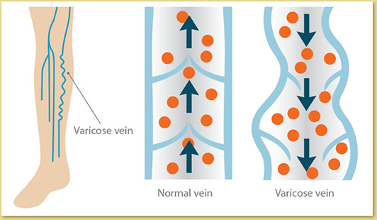 Illustration showing normal and varicose veins